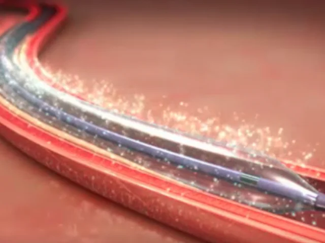 Drug-Coated Balloons for Dysfunctional Dialysis Arteriovenous Fistulas